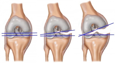 Повреждение мениска коленного сустава – виды лечения